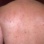 Memahami Gangguan Pada Kulit Dan Cara Mengatasinya